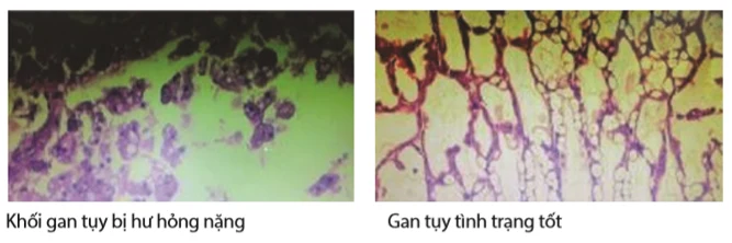 Ảnh mô học gan tụy: bên trái khối gan tụy bị hư hỏng nặng, bên phải gan tụy tình trạng tốt
